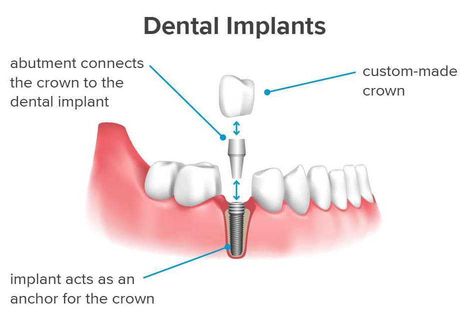 dental implant