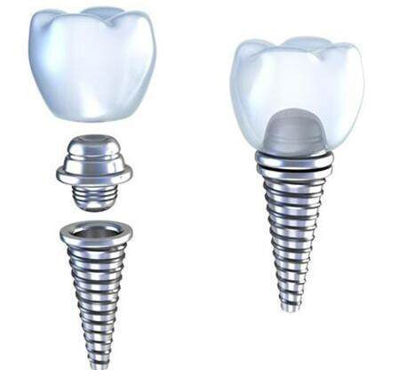 Procedure of dental implant | Xmystool.com